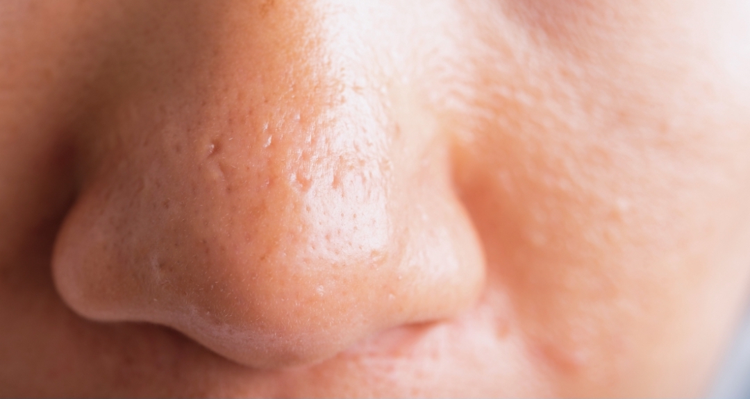 enlarged pores on nose