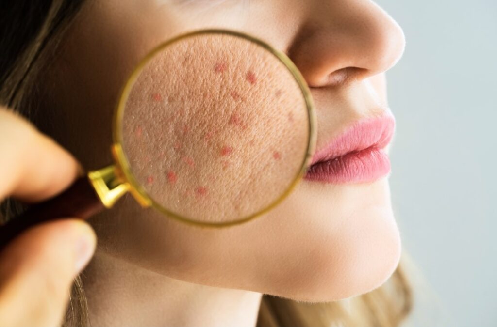 acne on woman's face