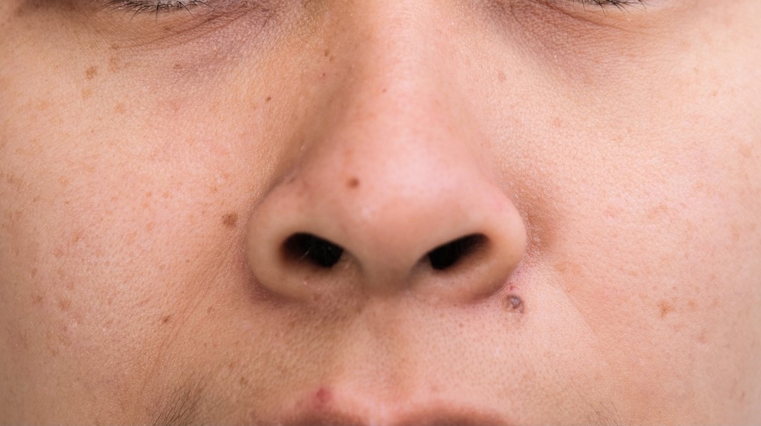 dark spots on face