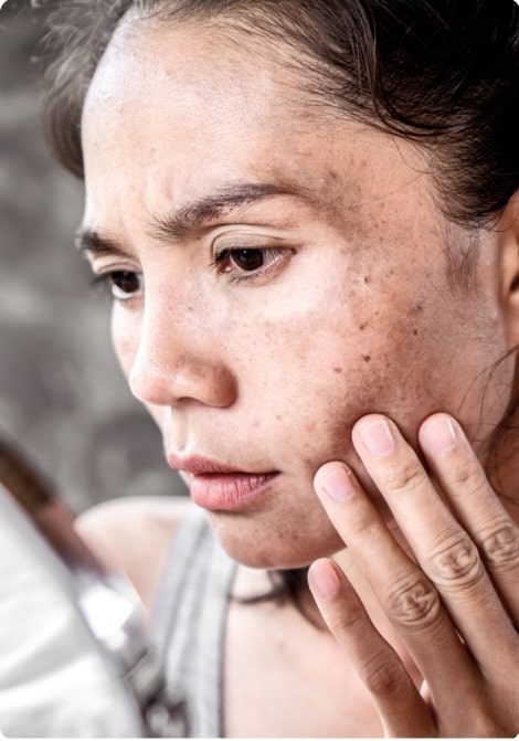 woman unhappy with her hyperpigmented skin1