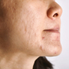 Hypertropic acne scar