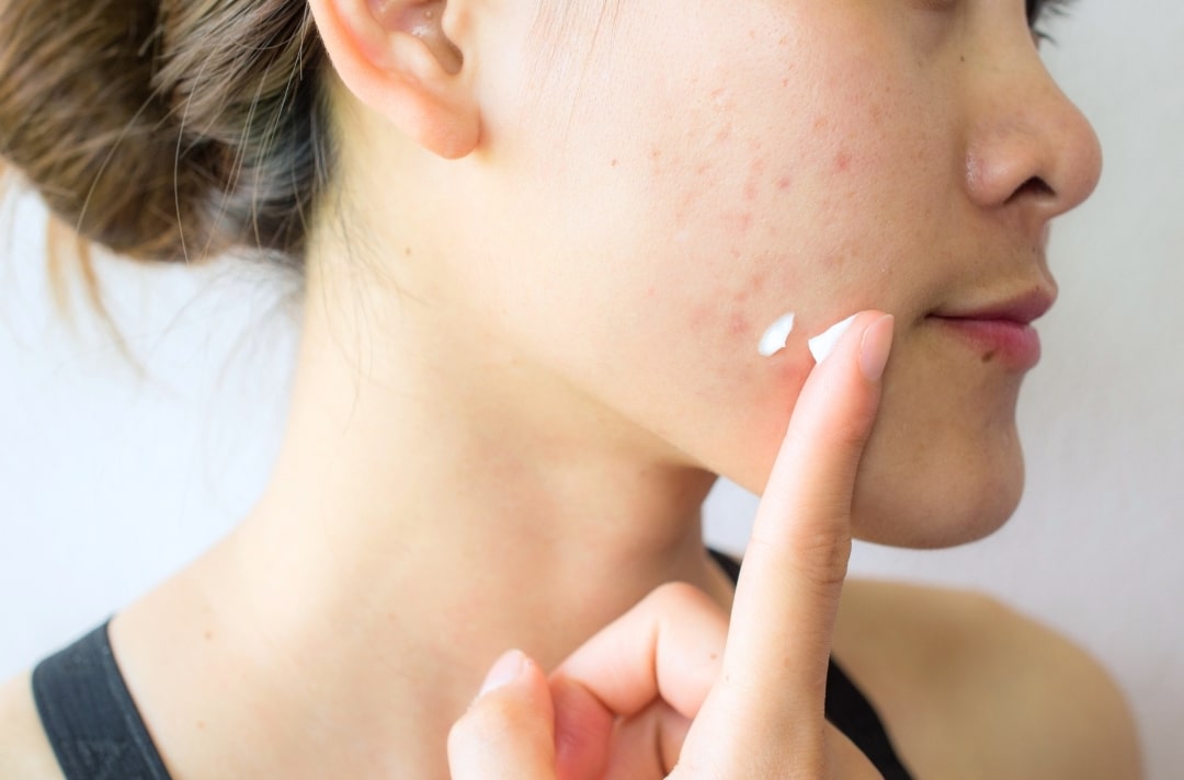 woman applying topical acne treatment on face