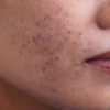 brown acne scar