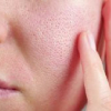 ice peak acne scars