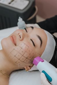 Radiofrequency on face