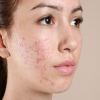 acne on woman's cheek