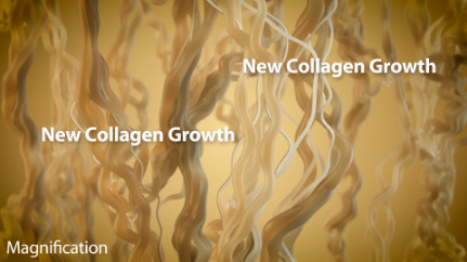 new collagen growth (magnification version)