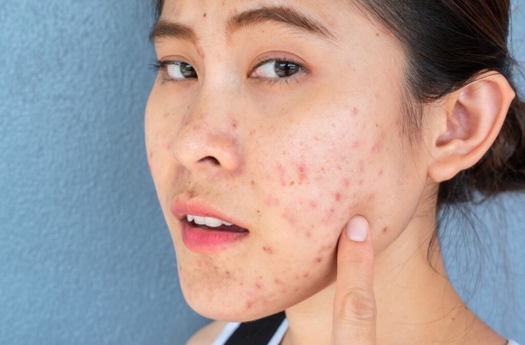 woman having acne scar on face