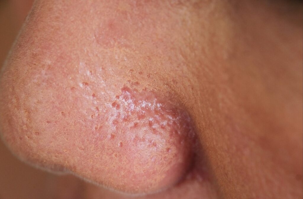 enlarged pores on nose