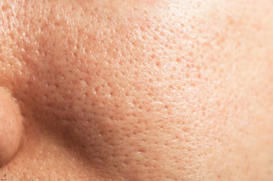 enlarged pores on nose