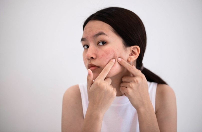 woman popping acne