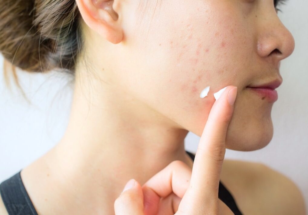 woman applying topical acne treatment on face