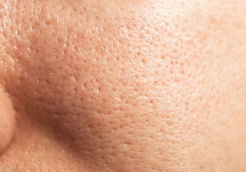 enlarged pores on nose